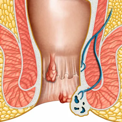 Геморрой при беременности: признаки, симптомы, лечение, чем опасен, как  избежать