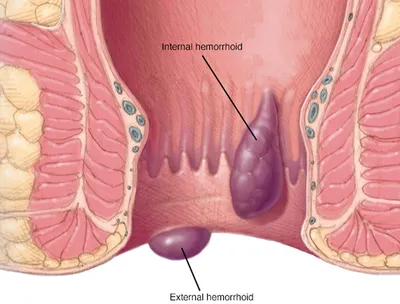 Заворот большой ободочной кишки у лошадей. Диагностика и лечение / Equine  large colon volvulus. Diagnosis and treatment