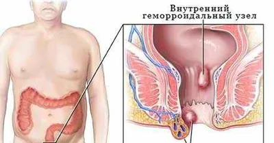 Амебиаз - причины появления, симптомы заболевания, диагностика и способы  лечения