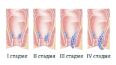 Геморрой: причины, симптомы, лечение