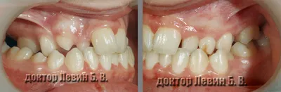 Из десны торчит острая кость - Вопрос стоматологу - 03 Онлайн