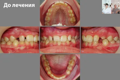 О наращивании костной ткани! Поделитесь бывалые... | Дневник пользователя  Сладкая вишенка | Брекет.Info