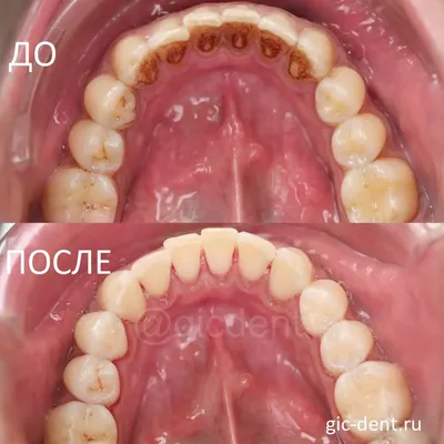 Перикоронит зуба мудрости: симптомы заболевания, лечение воспаления  капюшона десны, удаление