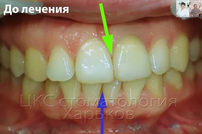 Расширение челюсти. Без винта и не туда, и не сюда