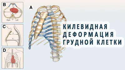 Килевидная деформация грудной клетки - YouTube