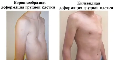 Деформация грудной клетки у детей: причины, симптомы, лечение -  beautyvertebro.com