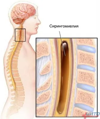 Тромбоз подключичной вены - лечение в Инновационном сосудистом центре:  симптомы и причины