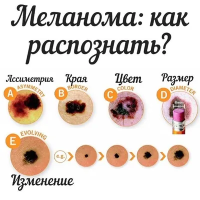 16 симптомов меланомы: что делать если нашли один?