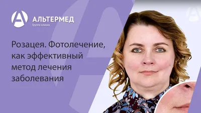 Угревая сыпь и прыщи – лечение акне, причины, симптомы | Клиника \"Отражение\"