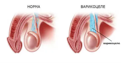 Водянка яичка - причины появления, симптомы заболевания, диагностика и  способы лечения