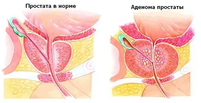 Злокачественные новообразования яичка — Википедия