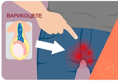 Боль в яичках (мошонке) у мужчины - симптомы и лечение | Клиника МедПросвет