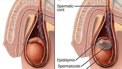 Сперматоцеле (киста яичка), симптомы и последствия. Удаление кисты яичка.
