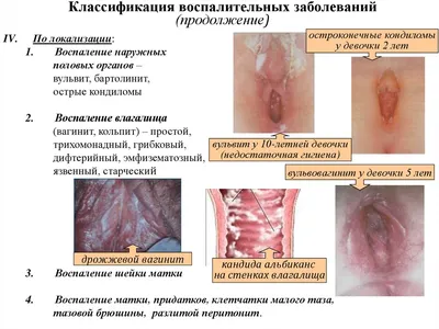 Воспалительные заболевания женских половых органов - презентация онлайн