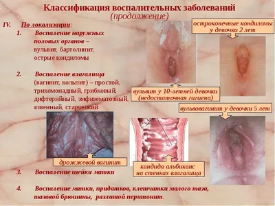 Воспалительные заболевания женских половых органов - презентация, доклад,  проект