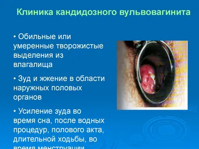 Воспалительные заболевания органов малого таза (ВЗОМТ). Диагностика и  лечение