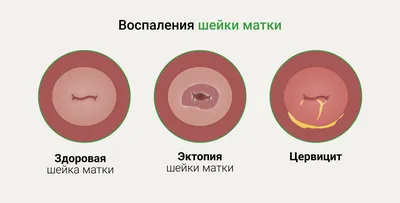 Эндометриоз матки – симптомы, лечение, диагностика