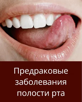 Заболевания полости рта и их возможные неизлечимые последствия. | Dental  Plats - стоматология СПБ | Дзен