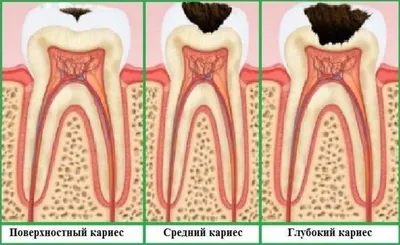 Неправильный прикус - виды, причины, симптомы, методы исправления