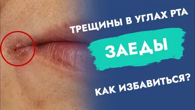 Что скрывают заеды❓🤔 ⠀ У вас появились трещины или воспаление в уголках  губ (рта)❓Это заеды (ангулярный хейлит), что является не просто… | Instagram