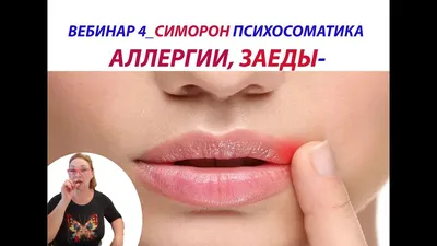 Solopharm - Что такое заеды и откуда они берутся Практически каждый  родитель замечал в уголках рта у своего ребенка небольшие воспаленные  трещинки и покраснения, которые никак не проходят. Это и есть заеды