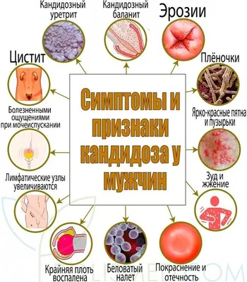 Узнайте все про симптомы и быстрое лечение молочницы у мужчин