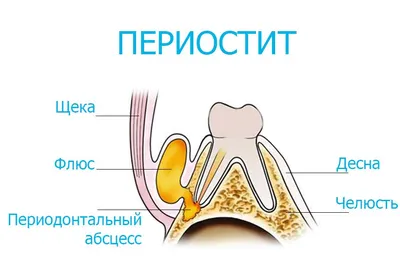 Флюс на десне - лечение в Москве — стоматология «Один к Одному» на  Войковской