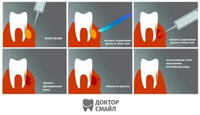 Флюс: причины, симптомы, методы лечения и профилактики | Dr.Miller