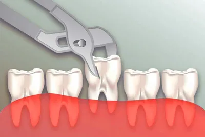 Флюс после удаления зуба мудрости — чем полоскать и сколько проходит в  статье Startsmile