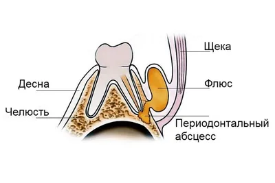 Флюс на десне: что это и как лечить, чтобы не навредить