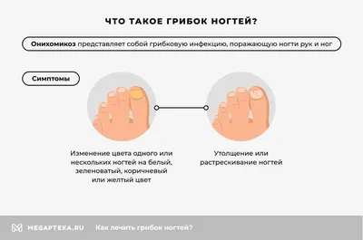 Грибковые заболевания на ногтях: признаки, причины и как их лечить?