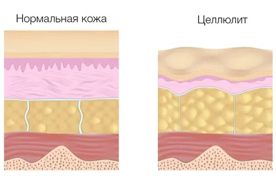 Крем для похудения, 60 мл, уход за телом, Эффективное сжигание жира, потеря  веса, кремы для похудения и стягивания ног, рук, крем для удаления целлюлита  TSLM1 | AliExpress