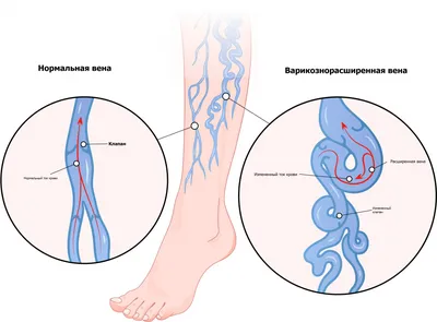 Варикозное расширение вен нижних конечностей.