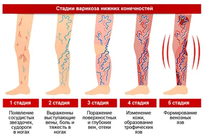 Варикоз: симптомы, стадии, эффективные методы лечения варикозного  расширения вен