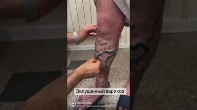 Инстаграм dr_mishenko #варикоз #варикозныеузлы #лечениеварикозалазером... |  TikTok