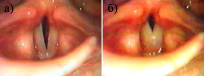 Видеоэндостробоскопическое исследование здоровых детей и с функциональными  заболеваниями гортани - СПб НИИ ЛОР