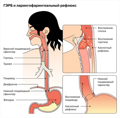 Фиброма гортани, диагностика и лечение в Сургуте | МЦ Докторплюс