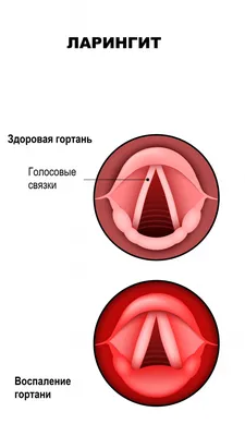 Причины затяжного кашля после ОРВИ