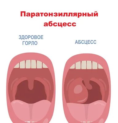 Не так безобидно. Что скрывается за ощущением «кома в горле» | Здоровая  жизнь | Здоровье | Аргументы и Факты