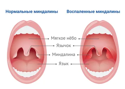 Здоровые миндалины фото