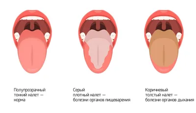 ИМПЛАНТАЦИЯ.ВИНИРЫ.СТОМАТОЛОГИЯ on Instagram: \"Уход за языком каждый день  утром и вечером избавляет от следующих проблем: 🪥защищает от кариозной  болезни, не давая вредным микробактериям образовывать кислоту, которая  разрушает эмаль; 🪥устраняет ...