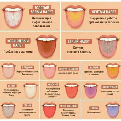 Что означает белый налет на языке