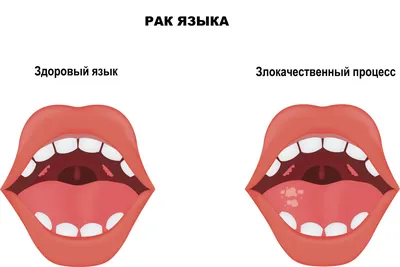 Язык человека: что это, где находится, как выглядит и работает, почему  может болеть