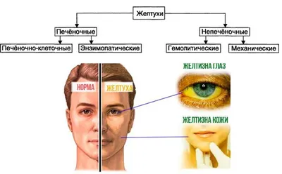 Желтуха у взрослых и детей: что это, причины, признаки, лечение