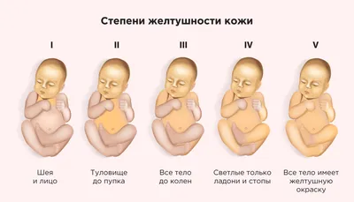 Желтуха у новорожденных - причины и последствия, сколько держится, лечение