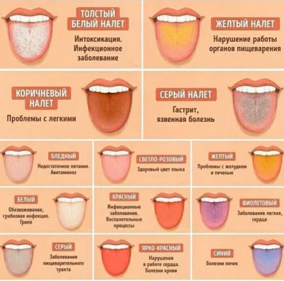 О чем говорит цвет языка и налет на нем? | ТвойВрач | Дзен