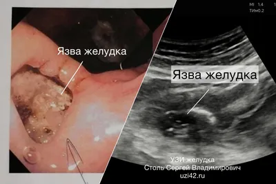 Может ли желудок опять растянуться после операции? - Евразийский центр  бариатрии