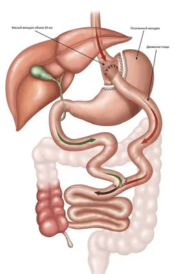 Размер желудка после резекции - Национальная бариатрическая практика
