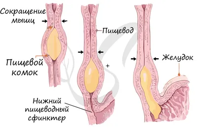 Эрозивный гастрит желудка: симптомы, лечение у взрослых, диета