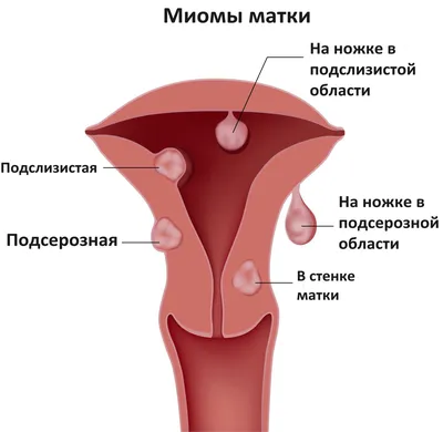 Гинекологические заболевания: список самых распространенных